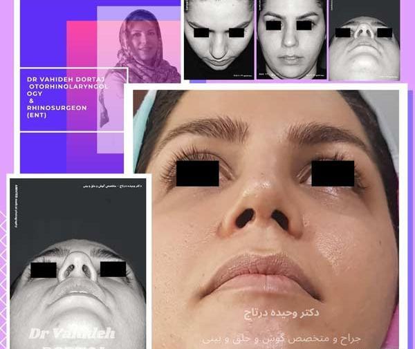 عکس قبل و بعد عمل انحراف بینی