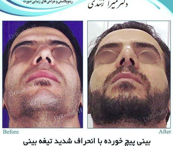 عکس قبل و بعد عمل انحراف بینی