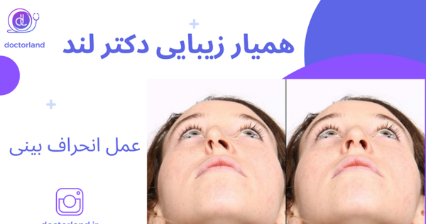 عکس قبل و بعد عمل انحراف بینی