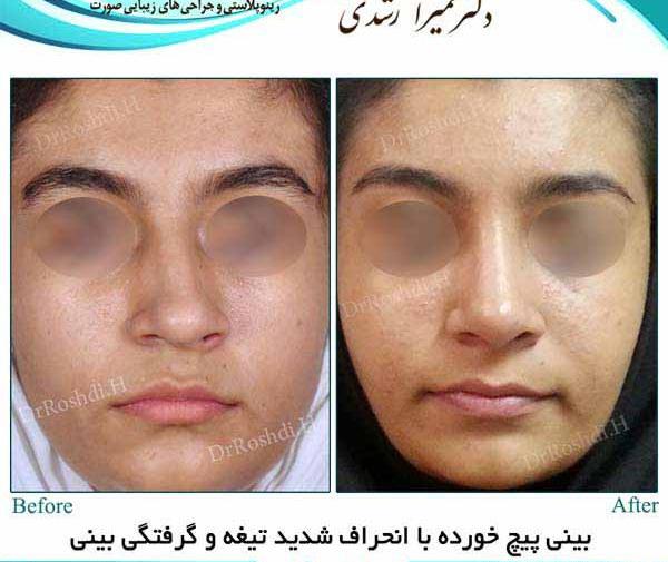 عکس قبل و بعد عمل انحراف بینی