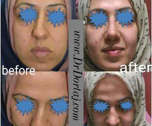 عکس قبل و بعد عمل انحراف بینی