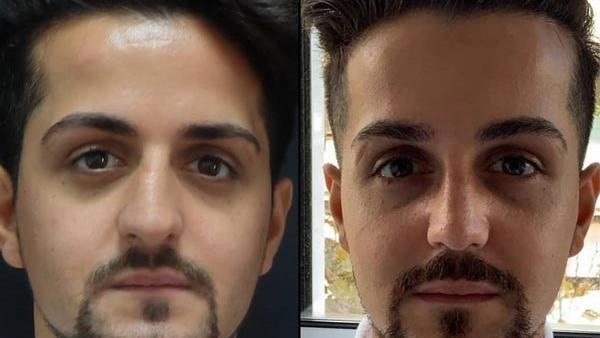 عکس قبل و بعد عمل انحراف بینی