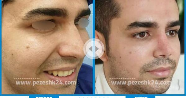 عکس قبل و بعد عمل انحراف بینی
