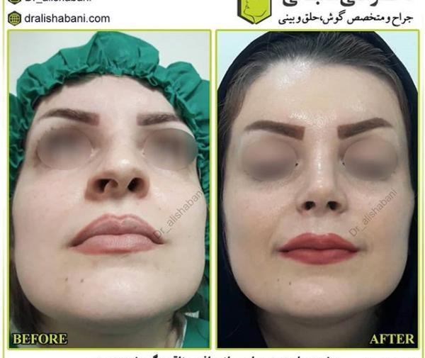 عکس قبل و بعد عمل انحراف بینی