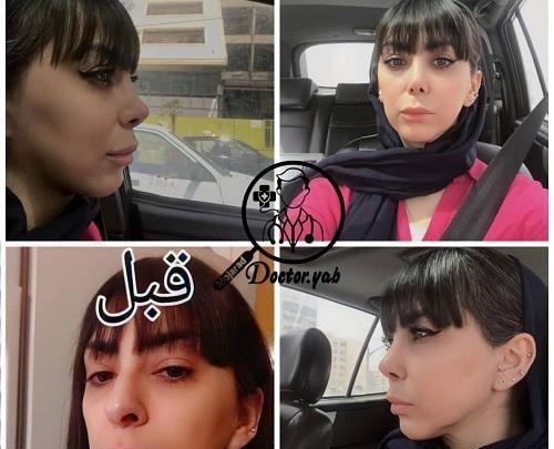 عکس قبل و بعد عمل انحراف بینی