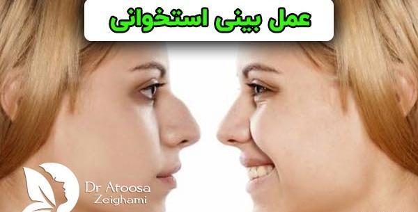 عکس قبل و بعد عمل انحراف بینی