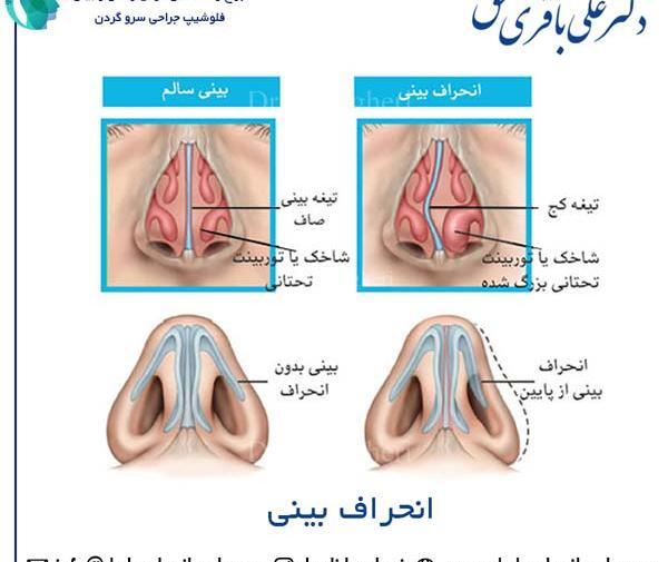 عکس قبل و بعد عمل انحراف بینی