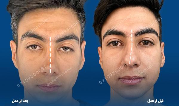 عکس قبل و بعد عمل انحراف بینی
