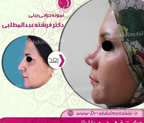 عکس قبل و بعد عمل انحراف بینی