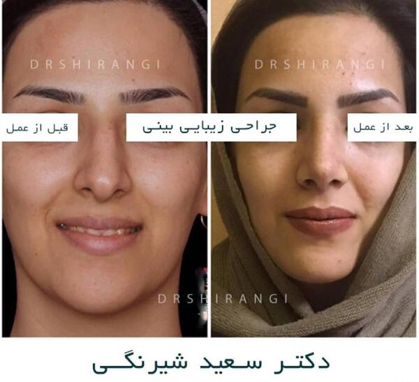 عکس قبل و بعد عمل انحراف بینی