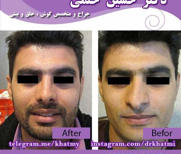 عکس قبل و بعد عمل انحراف بینی