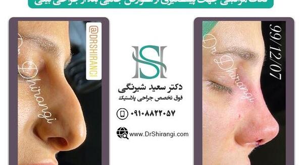 عکس قبل و بعد عمل انحراف بینی