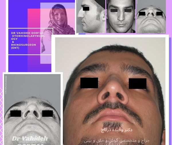 عکس قبل و بعد عمل انحراف بینی