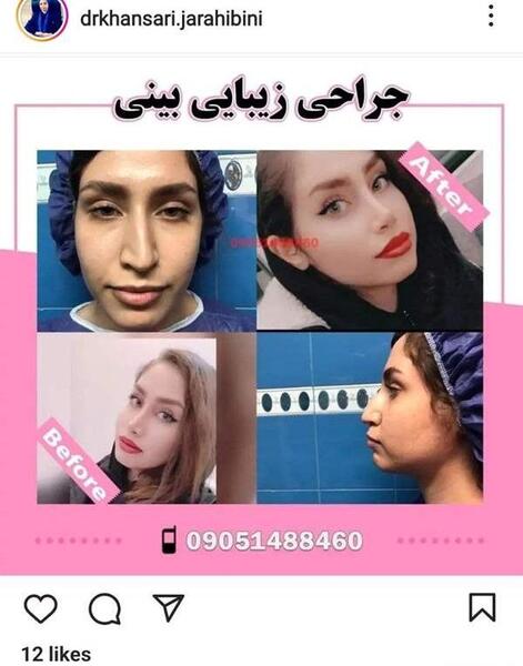 عکس قبل و بعد عمل بینی نی نی سایت