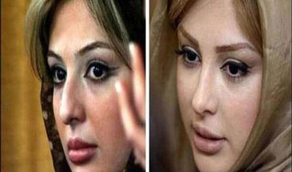 عکس قبل و بعد عمل بینی محمد حاتمی