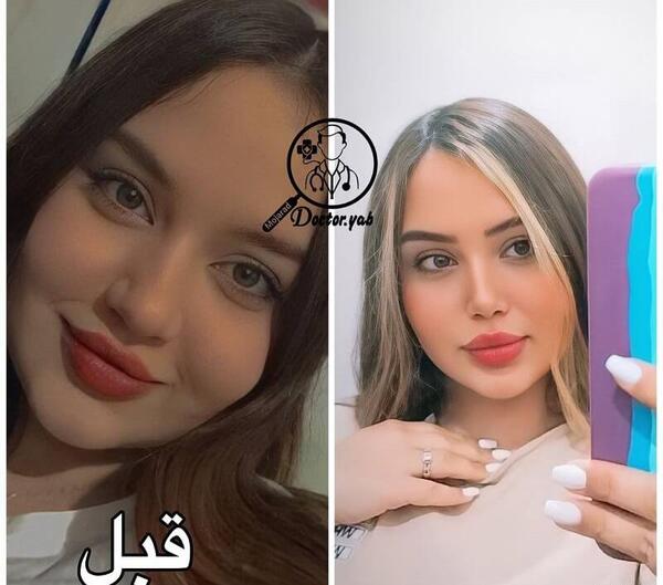 عکس قبل و بعد عمل بینی محمد حاتمی