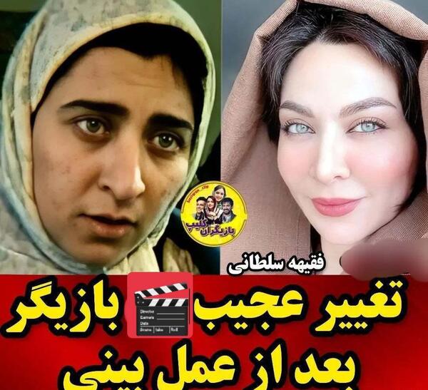 عکس قبل و بعد عمل بینی بازیگران