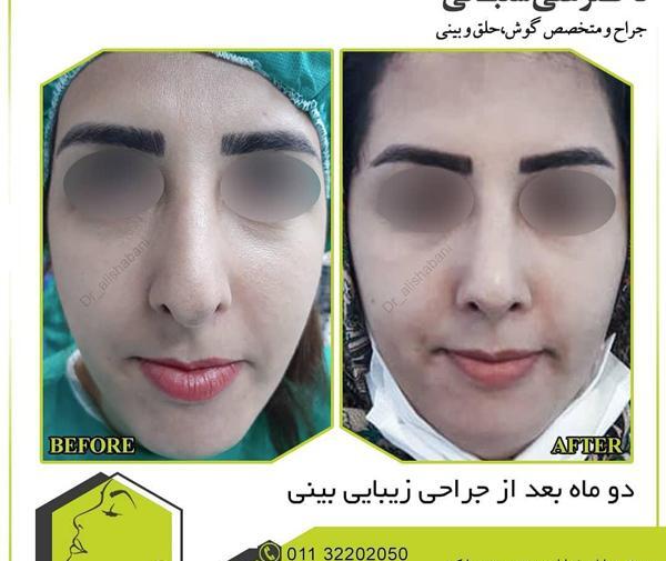 عکس قبل و بعد عمل بینی طبیعی