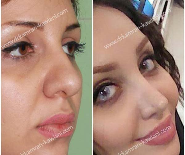 عکس قبل و بعد عمل بینی طبیعی