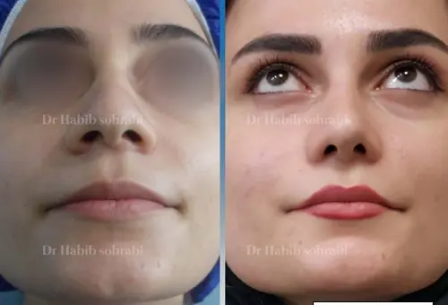 عکس قبل و بعد عمل بینی طبیعی