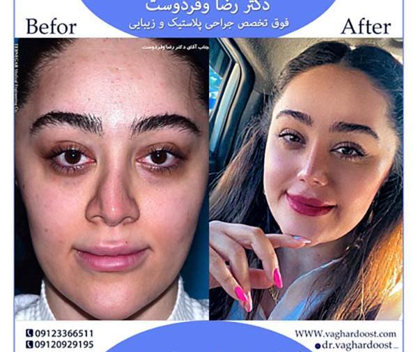 عکس قبل و بعد عمل بینی طبیعی