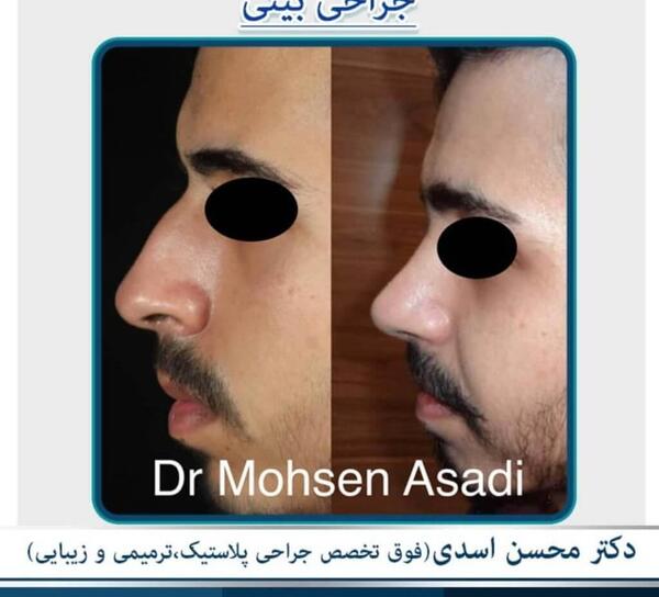 عکس قبل و بعد عمل بینی طبیعی