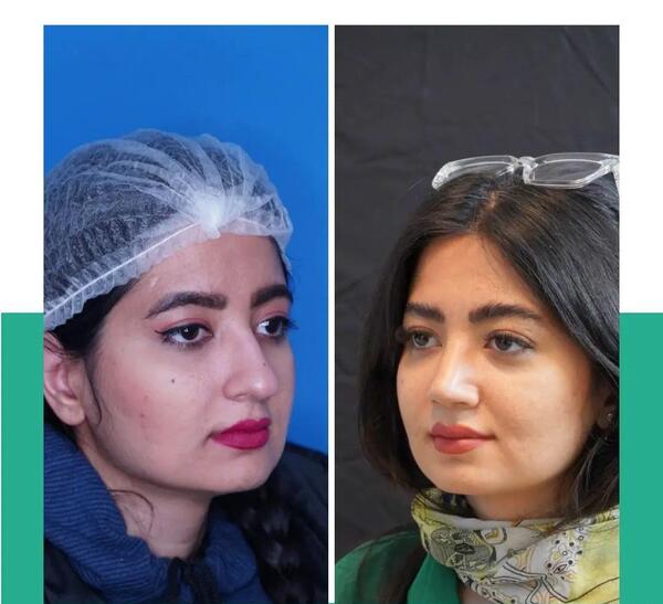 عکس قبل و بعد عمل بینی طبیعی
