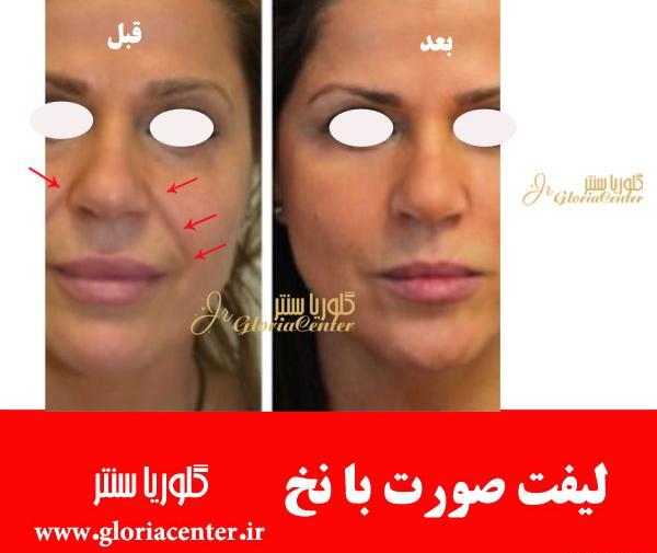 عکس قبل و بعد بوتاکس دور چشم