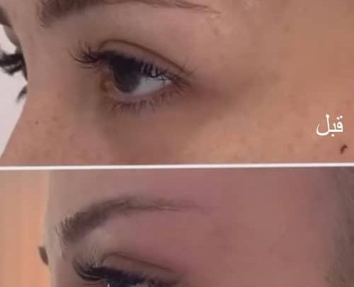 عکس قبل و بعد بوتاکس دور چشم