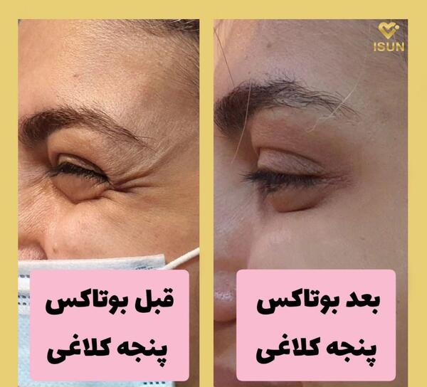 عکس قبل و بعد بوتاکس دور چشم