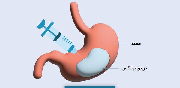 عکس قبل و بعد بوتاکس معده