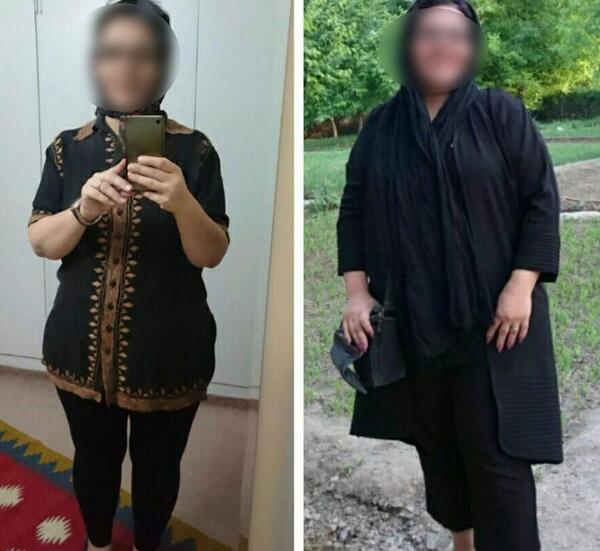 عکس قبل و بعد بوتاکس معده