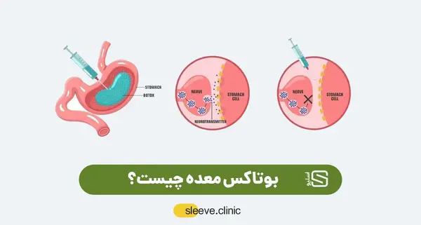 عکس قبل و بعد بوتاکس معده