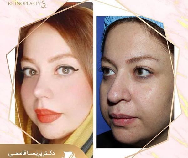 عکس قبل از جراحی بینی