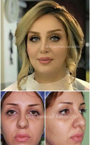 عکس قبل از جراحی بینی