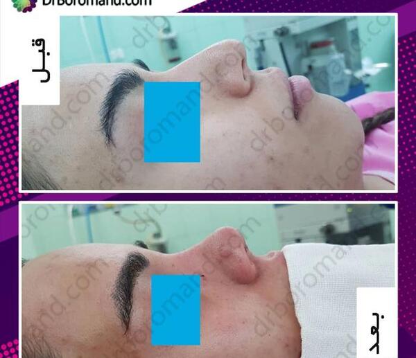 عکس قبل از جراحی بینی