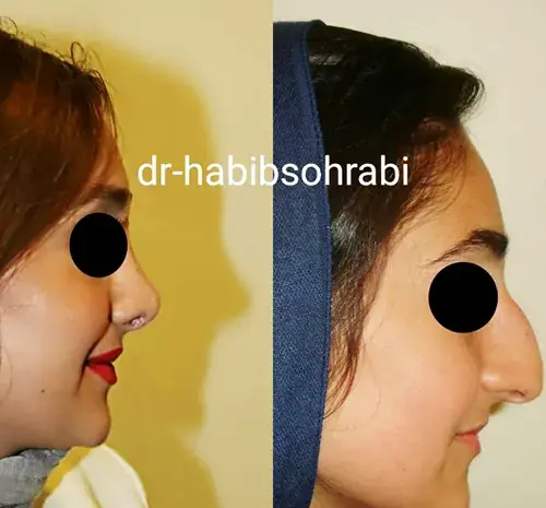 عکس قبل از جراحی بینی
