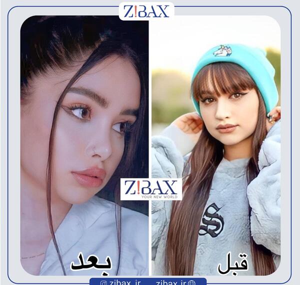عکس قبل از جراحی بینی