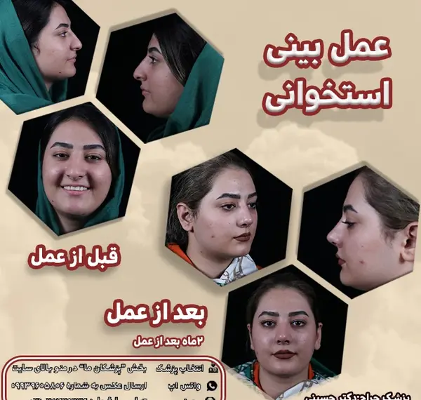 عکس قبل و بعد جراحی بینی