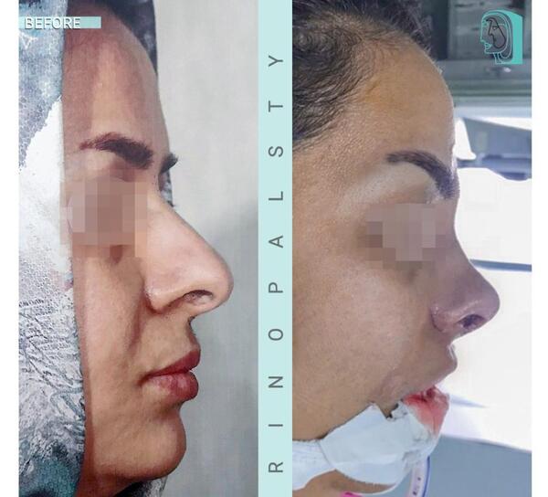 عکس قبل و بعد جراحی بینی