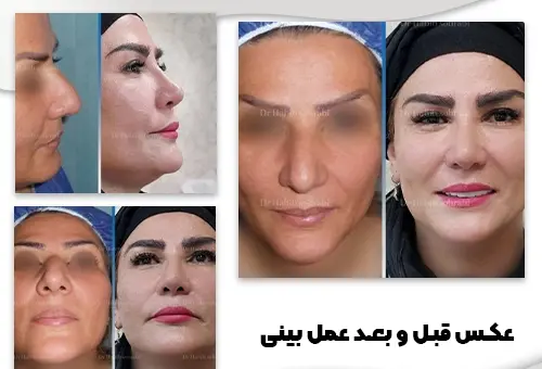 عکس قبل و بعد جراحی بینی