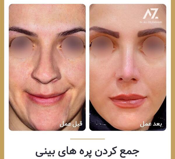 عکس قبل و بعد جراحی بینی