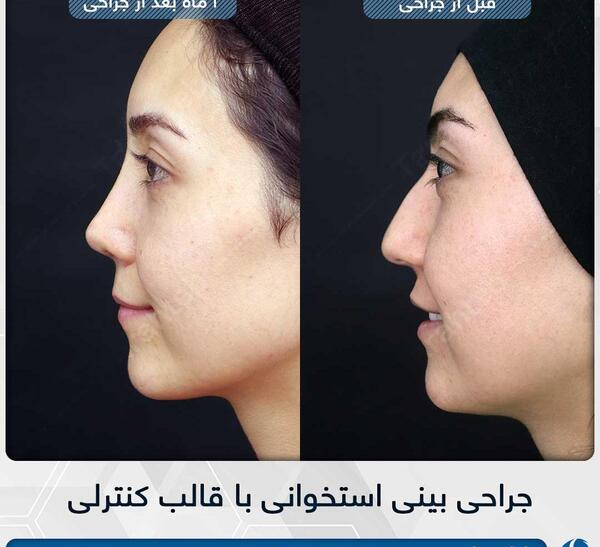 عکس قبل و بعد جراحی بینی