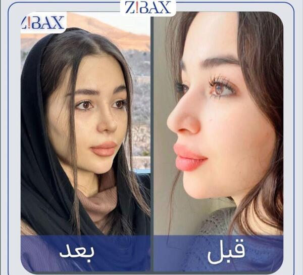 عکس قبل و بعد جراحی بینی