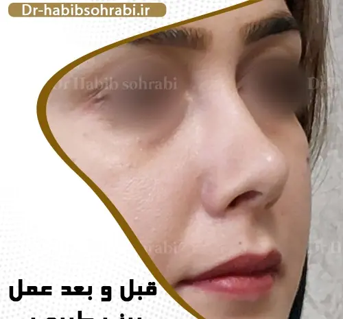 عکس قبل و بعد جراحی بینی