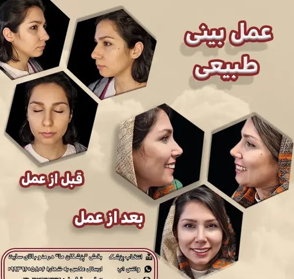 عکس قبل و بعد جراحی بینی