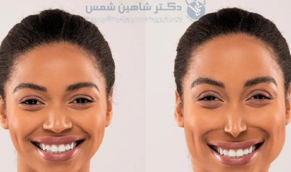 عکس برداری قبل جراحی بینی