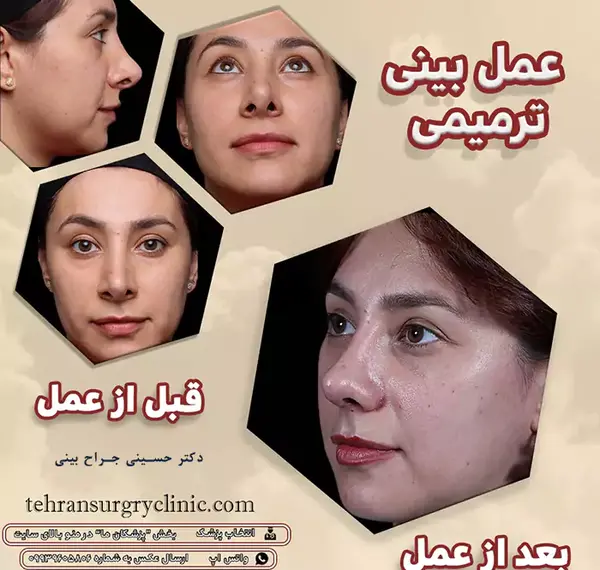 عکس برداری قبل جراحی بینی