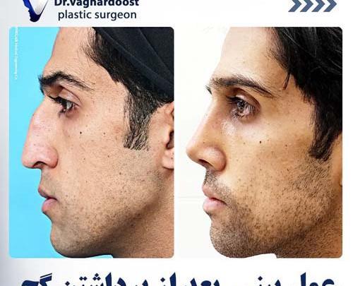 عکس برداری قبل جراحی بینی