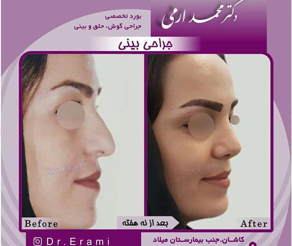 عکس برداری قبل جراحی بینی